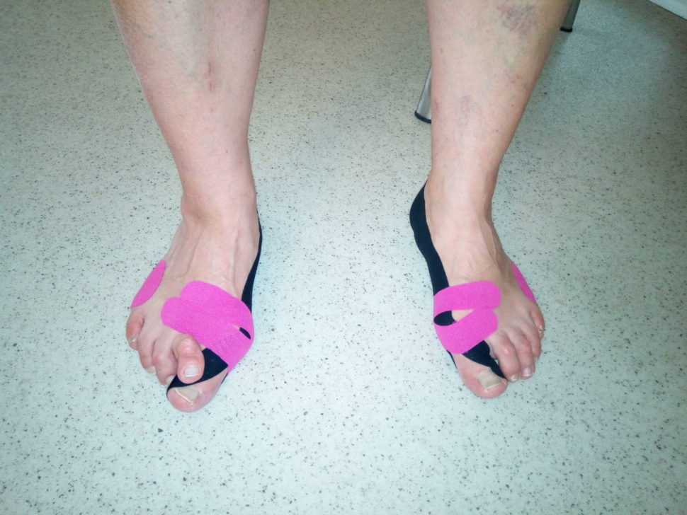Vbočený palec (hallux valgus) hrůza nebo to má řešení?